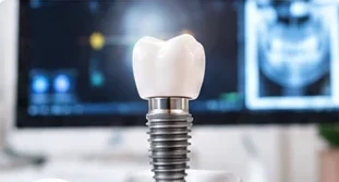 Dental implant model